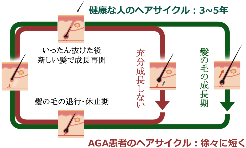 健康な人とAGA患者のヘアサイクル
